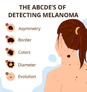 What Causes Moles And Freckles To Suddenly Appear